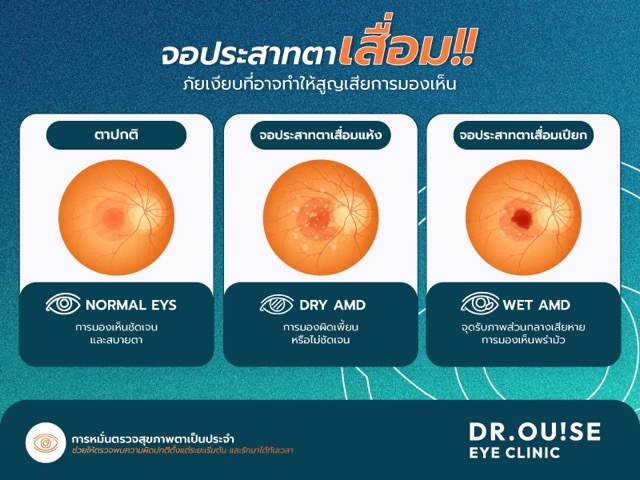 แสงสีฟ้า อันตรายแค่ไหน? วิธีป้องกันโรคจอประสาทตาสำหรับมนุษย์ออฟฟิศ