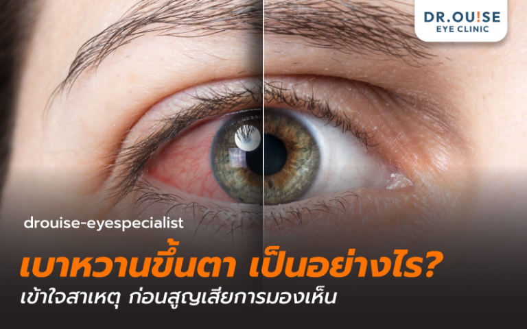 เบาหวานขึ้นตา เป็นอย่างไร? เข้าใจสาเหตุ ก่อนสูญเสียการมองเห็น